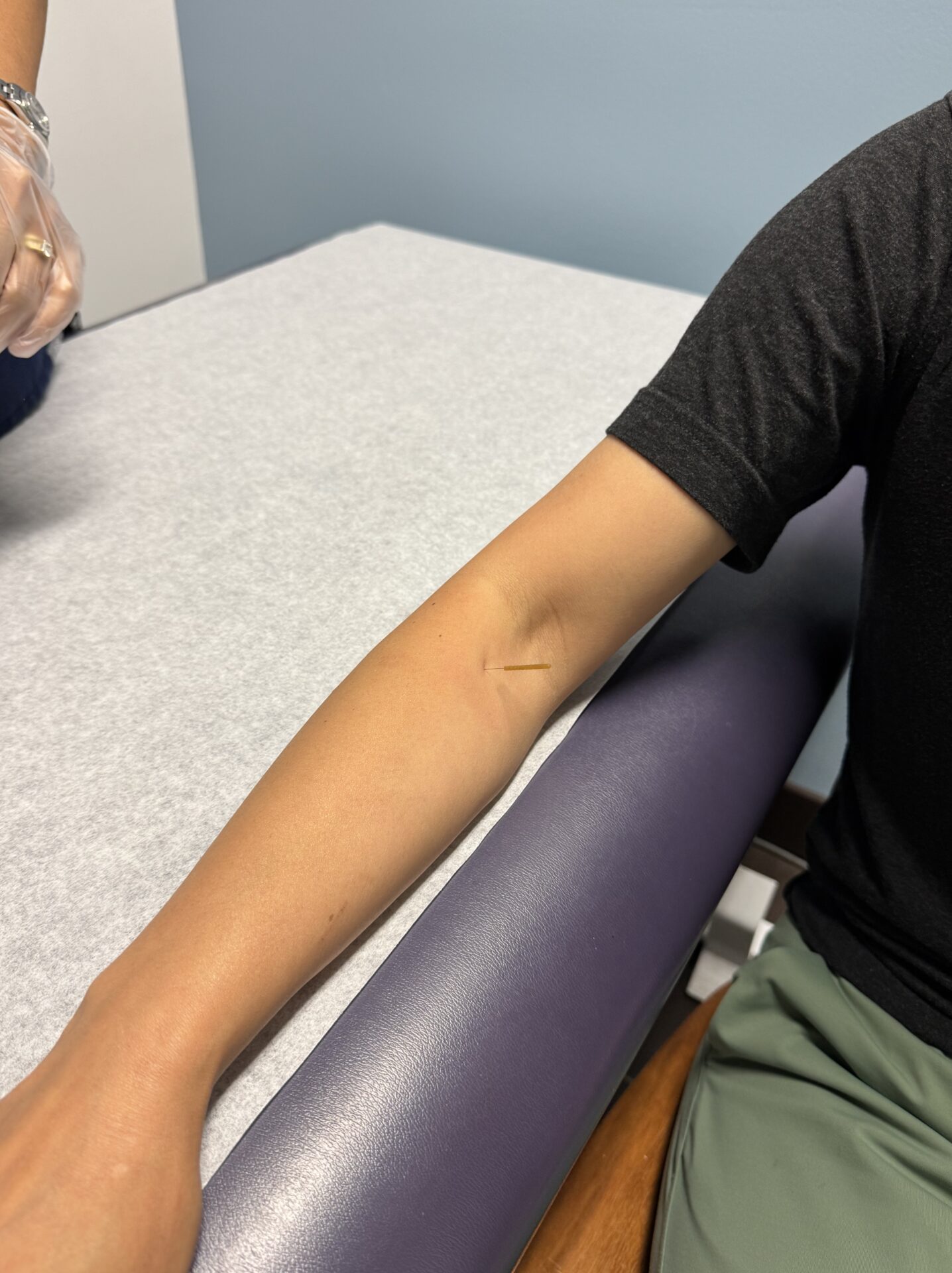 Patient receiving dry needling for elbow pain at Cross Roads Physiotherapy & Massage Therapy clinic in Vancouver
