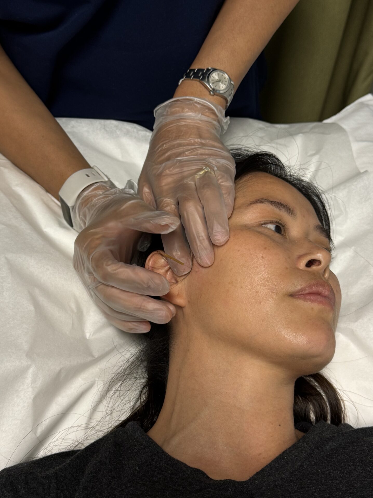 Patient receiving dry needling for jaw pain and TMJ problems at Cross Roads Physiotherapy & Massage Therapy clinic in Vancouver