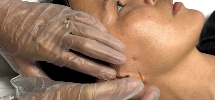 Patient receiving IMS needling treatment to her TMJ for her jaw tension and pain at Vancouver clinic Cross Roads Physiotherapy & Massage Therapy