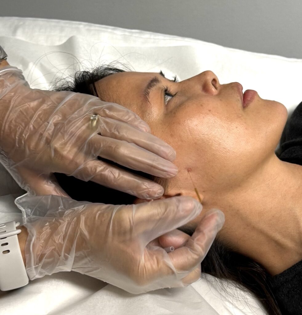 Patient receiving IMS needling treatment to her TMJ for her jaw tension and pain at Vancouver clinic Cross Roads Physiotherapy & Massage Therapy